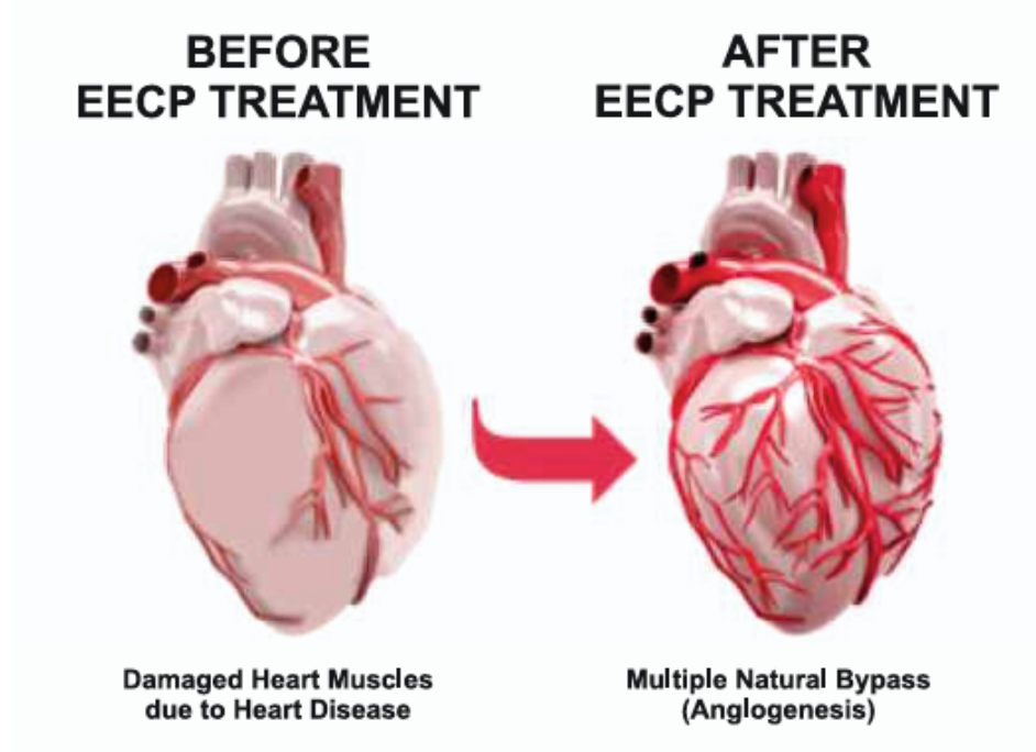 EECP Before and After Treatment